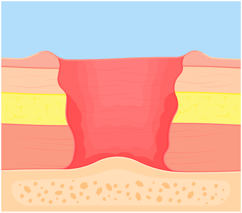 Diagram of a stage four bed sore